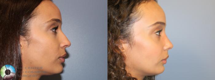 Best Denver Rhinoplasty