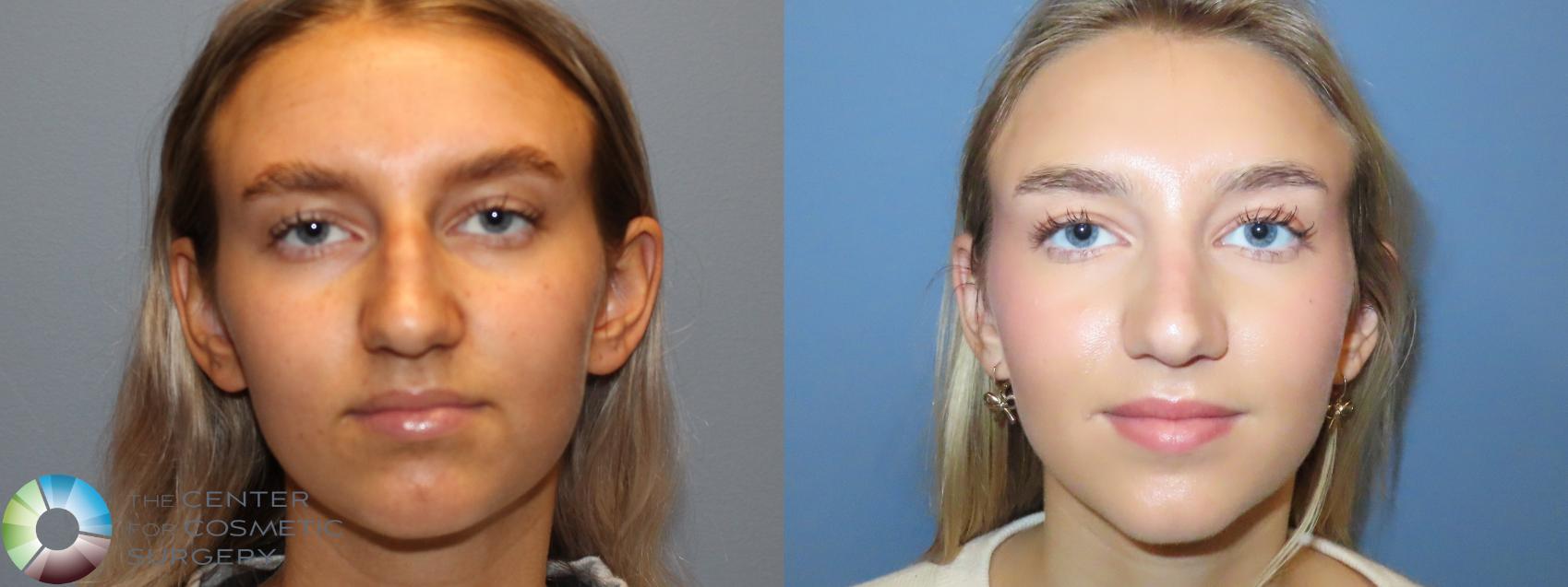 Before & After Rhinoplasty Case 12094 Front in Denver and Colorado Springs, CO