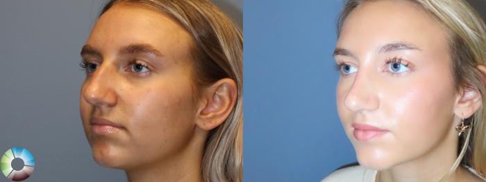 Best Denver Rhinoplasty