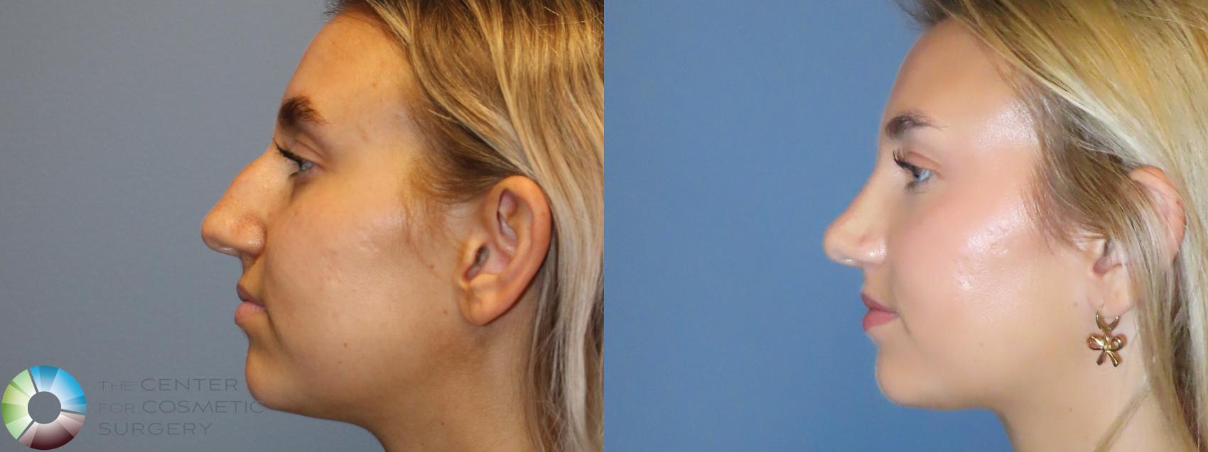 Before & After Rhinoplasty Case 12094 Left Side in Denver and Colorado Springs, CO