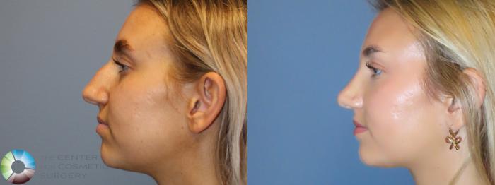 Best Denver Rhinoplasty