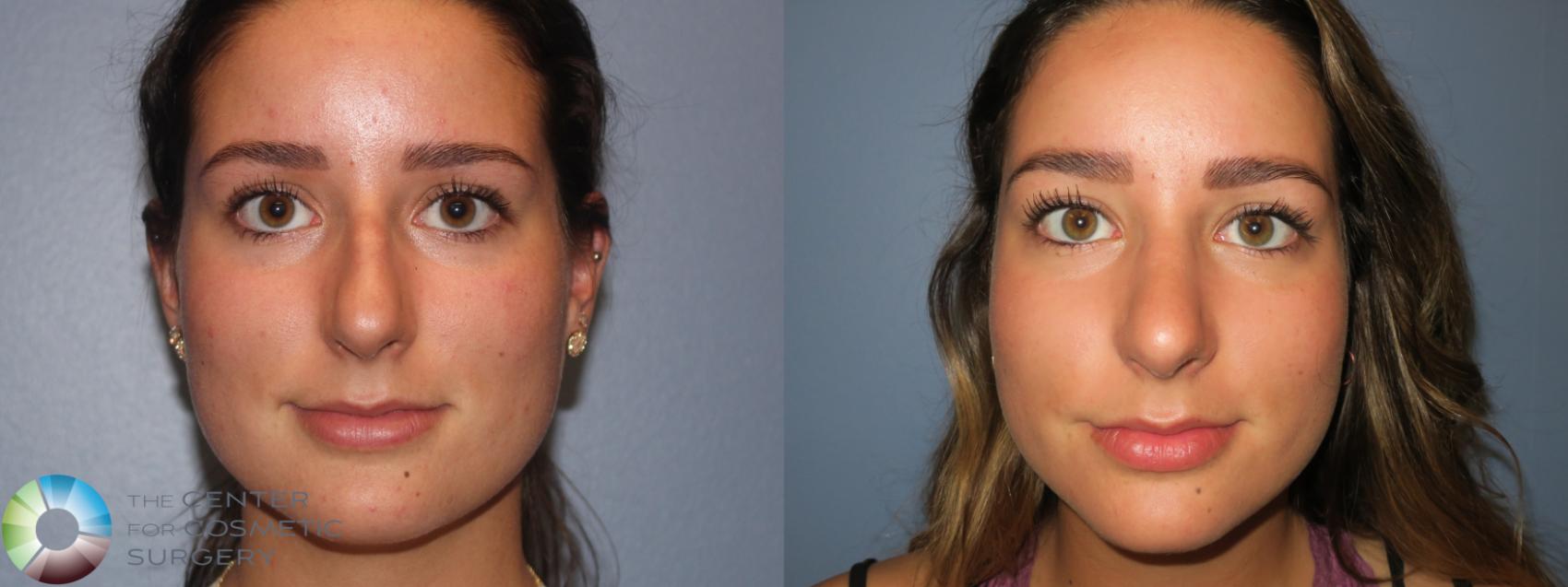 Before & After Rhinoplasty Case 12098 Front in Denver and Colorado Springs, CO