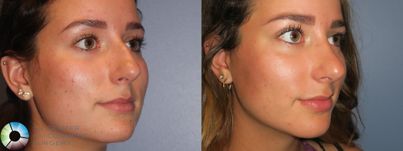 Best Denver Rhinoplasty