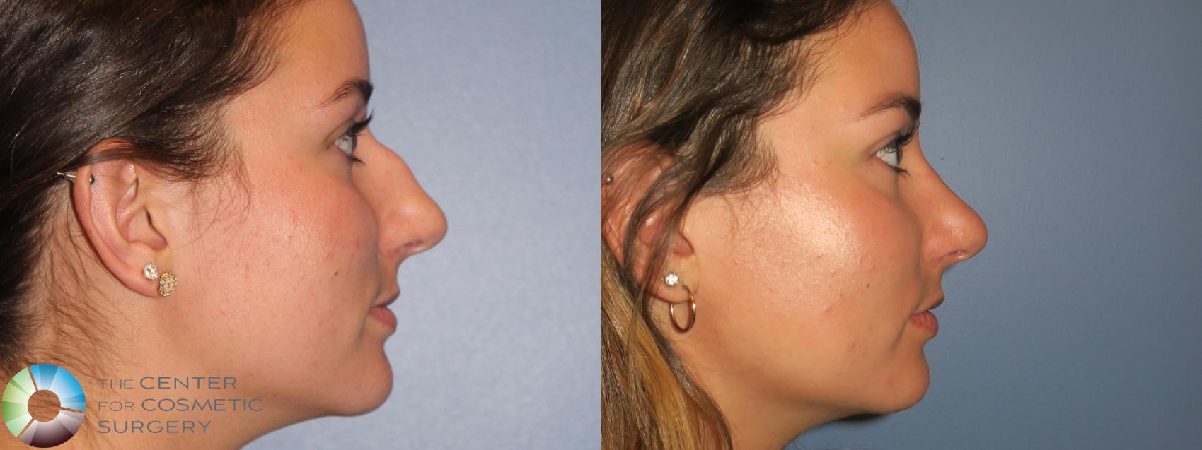 Before & After Rhinoplasty Case 12098 Right Side in Denver and Colorado Springs, CO