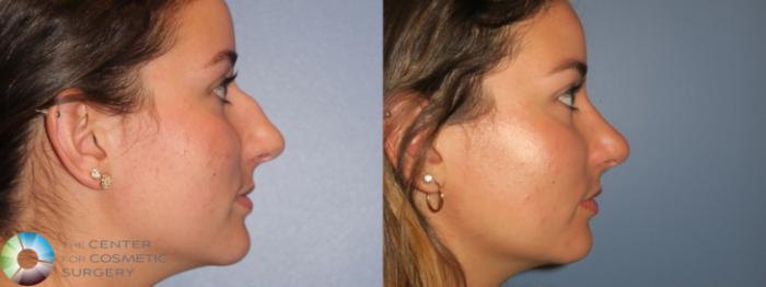 Best Denver Rhinoplasty