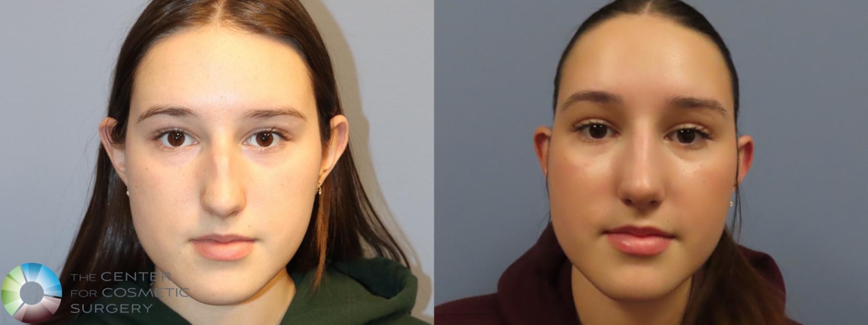 Before & After Rhinoplasty Case 12099 Front in Denver and Colorado Springs, CO
