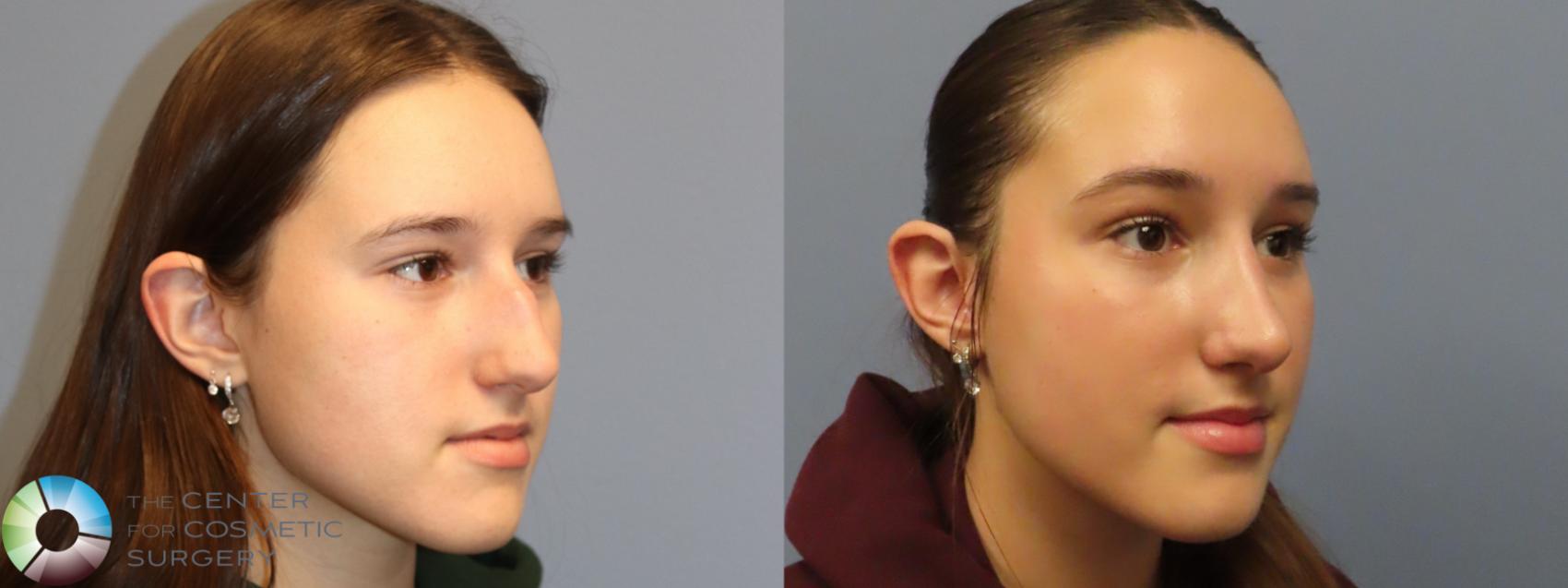 Before & After Rhinoplasty Case 12099 Right Oblique in Denver and Colorado Springs, CO