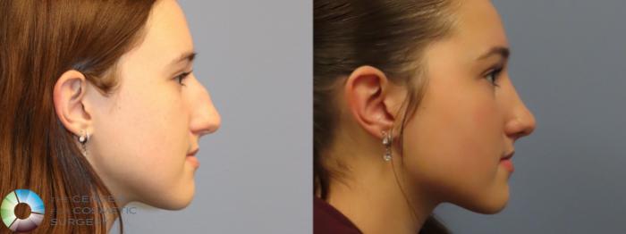 Best Denver Rhinoplasty