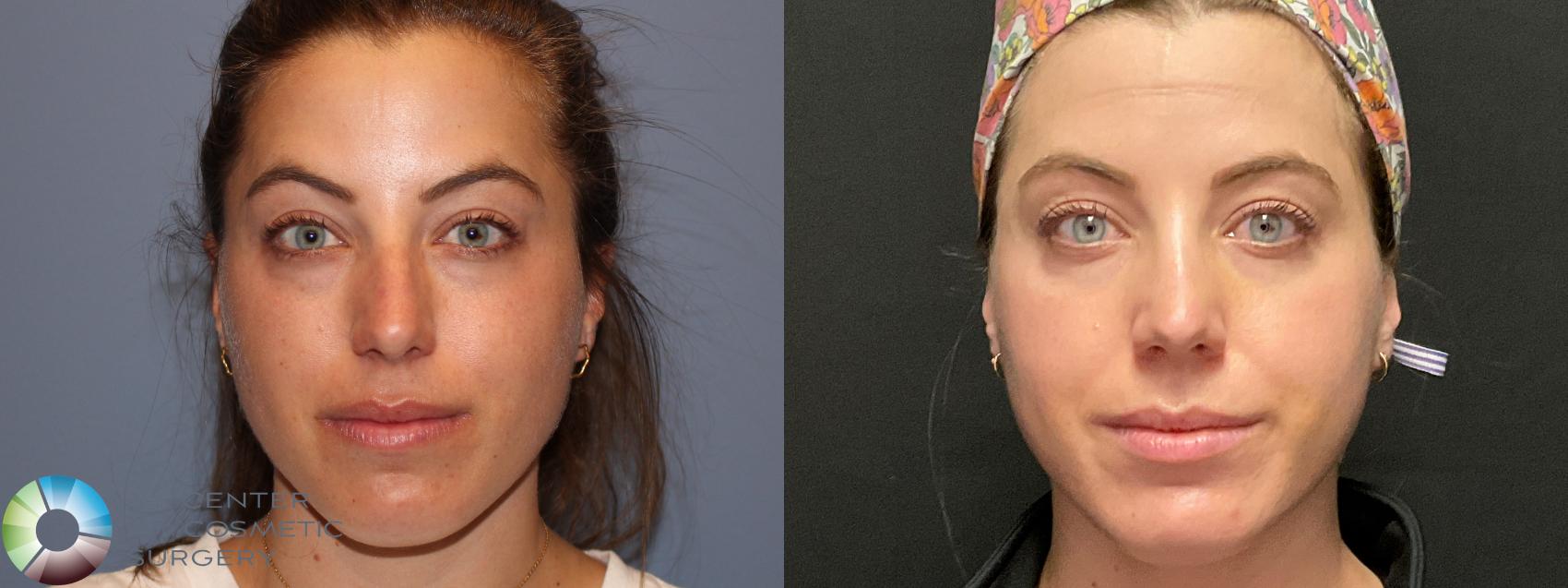 Before & After Rhinoplasty Case 12126 Front in Denver and Colorado Springs, CO