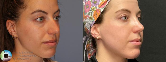 Best Denver Rhinoplasty