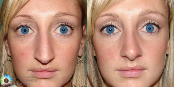 健康・医学 Preservation Rhinoplasty Quality Medical Publishing