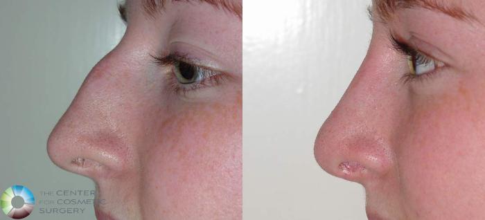Before & After Rhinoplasty Case 567 View #1 View in Golden, CO