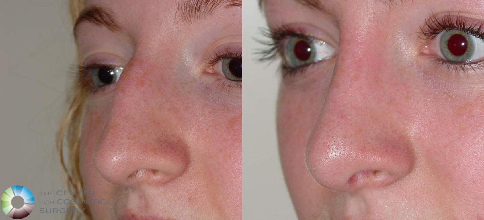 Before & After Rhinoplasty Case 567 View #2 in Denver and Colorado Springs, CO