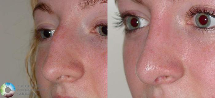 Before & After Rhinoplasty Case 567 View #2 View in Golden, CO