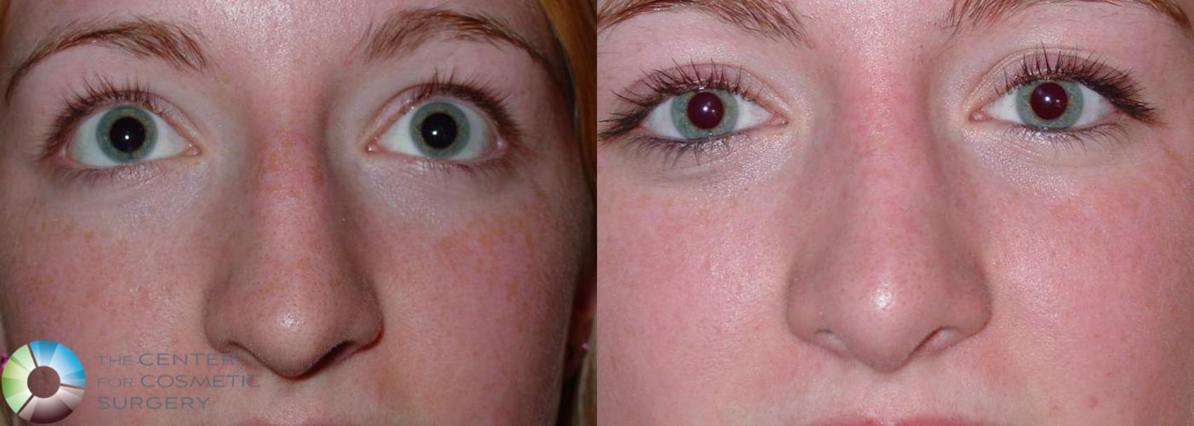 Before & After Rhinoplasty Case 567 View #3 in Denver and Colorado Springs, CO