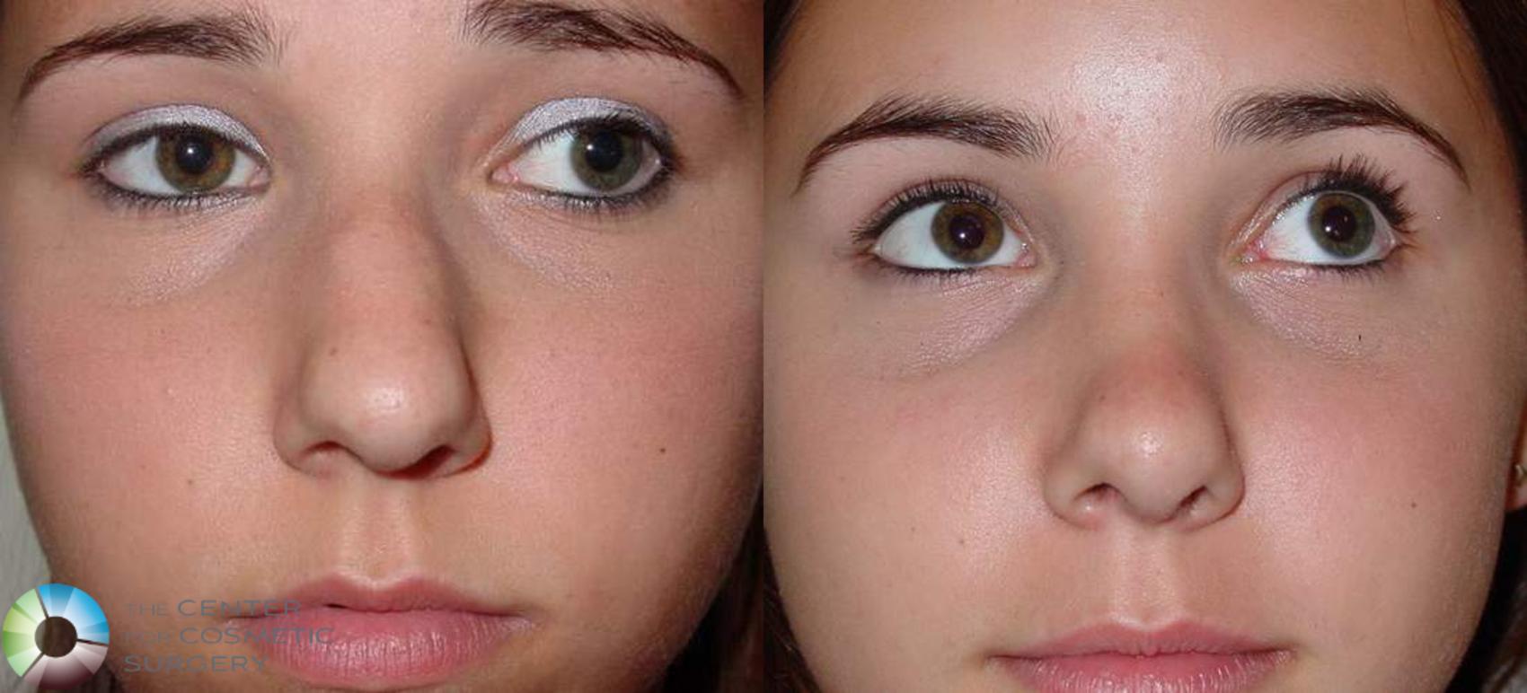 Before & After Rhinoplasty Case 568 View #1 in Denver and Colorado Springs, CO