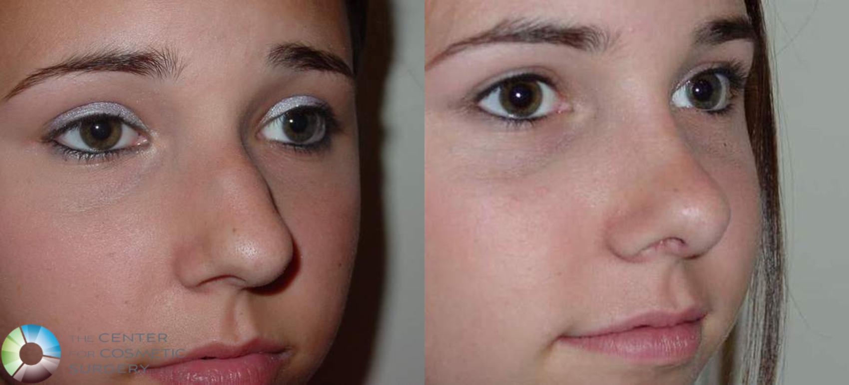 Before & After Rhinoplasty Case 568 View #2 in Denver and Colorado Springs, CO