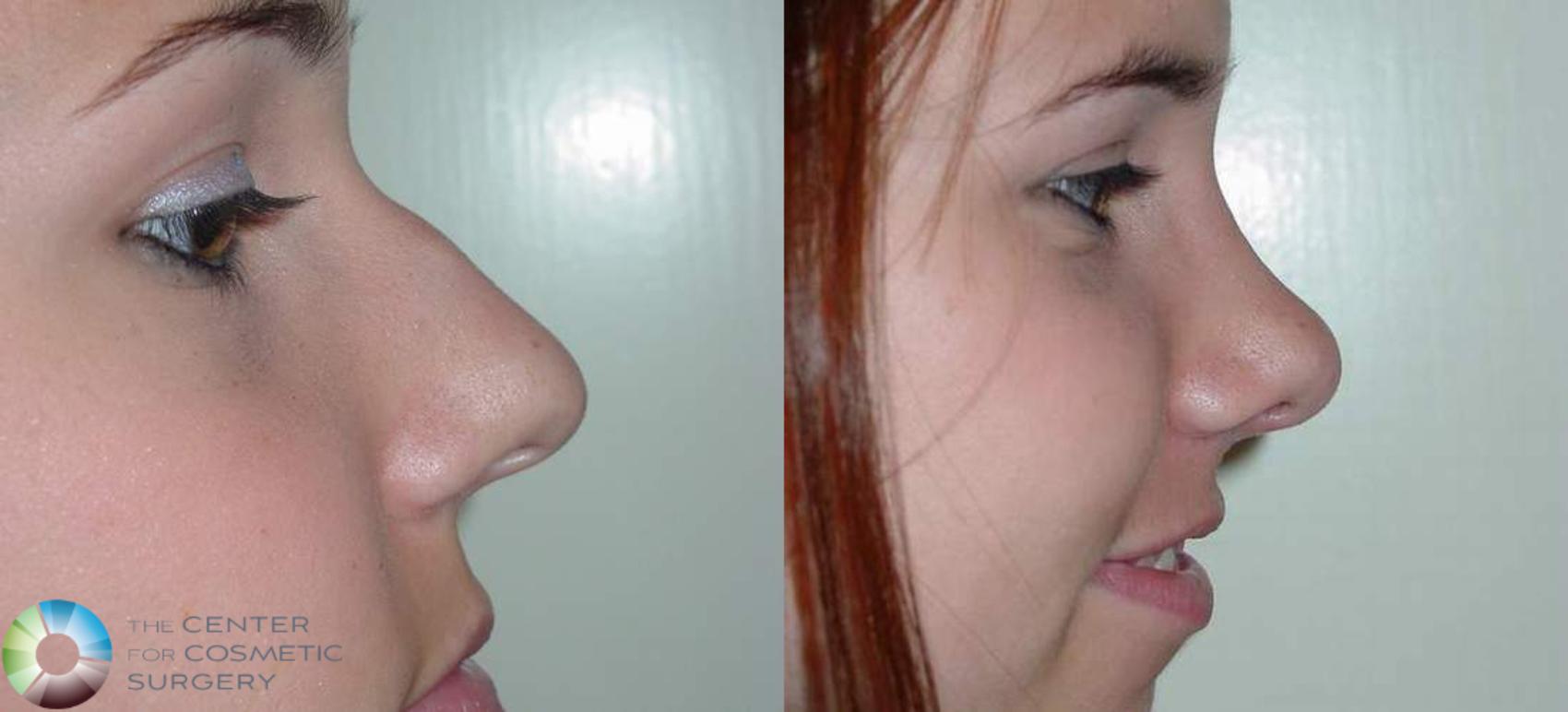 Before & After Rhinoplasty Case 568 View #3 in Denver and Colorado Springs, CO