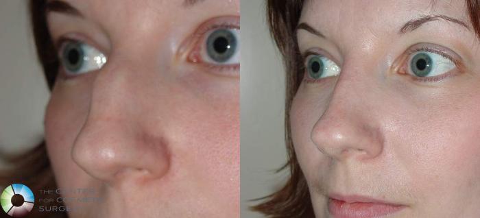 Before & After Rhinoplasty Case 569 View #2 View in Golden, CO