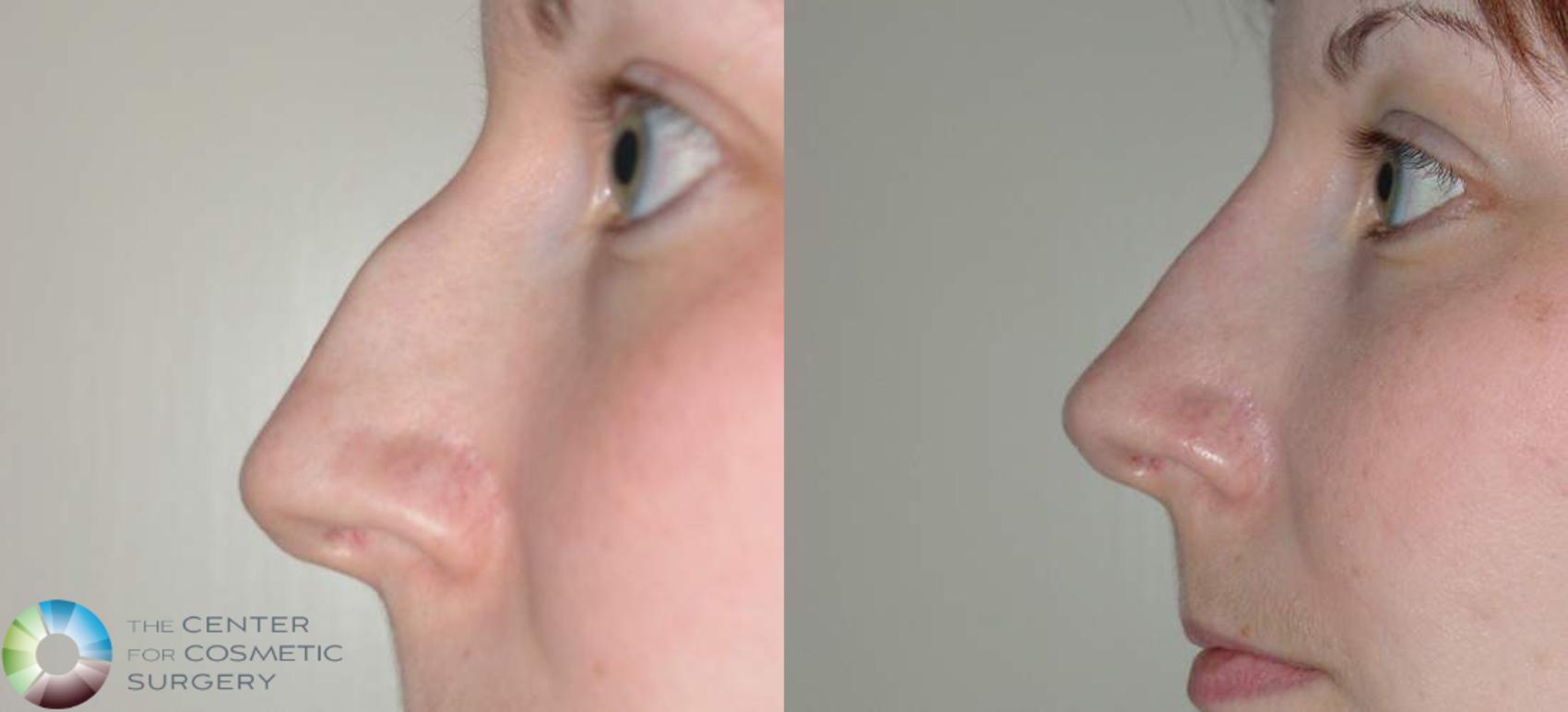 Before & After Rhinoplasty Case 569 View #3 View in Golden, CO