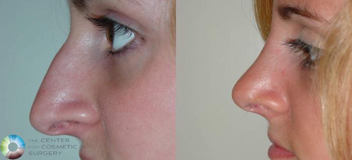 Before & After Rhinoplasty Case 570 View #1 View in Golden, CO