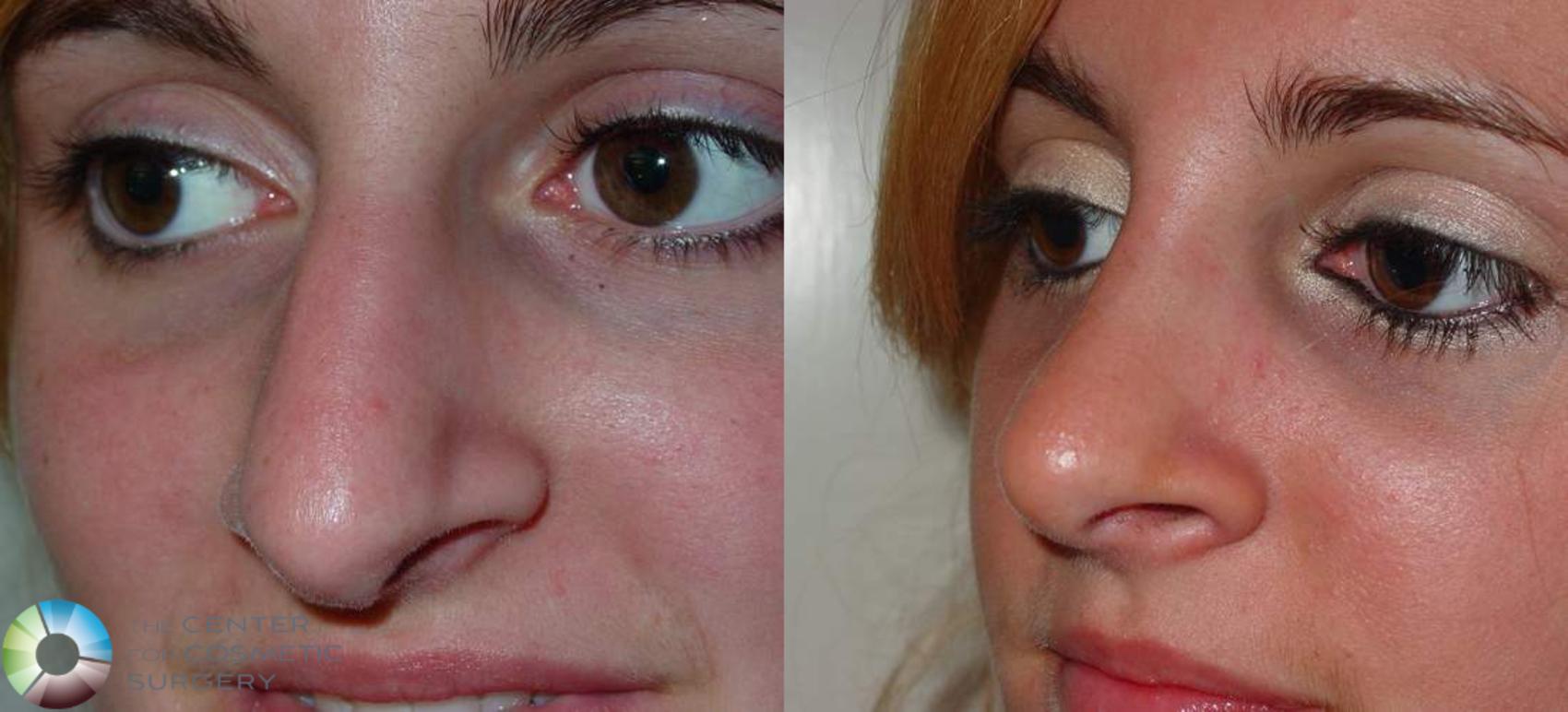 Before & After Rhinoplasty Case 570 View #2 View in Golden, CO