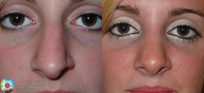 Before & After Rhinoplasty Case 570 View #3 View in Golden, CO