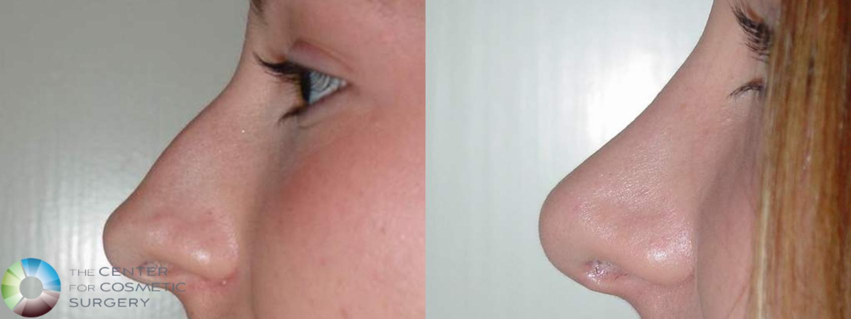 Before & After Rhinoplasty Case 571 Left side in Denver and Colorado Springs, CO