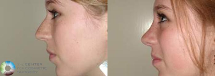 Before & After Rhinoplasty Case 572 View #1 View in Golden, CO