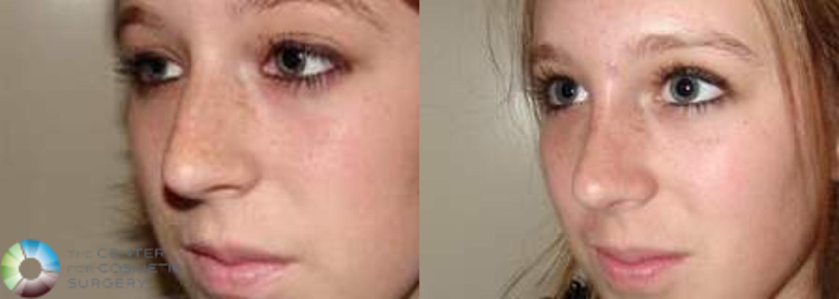 Before & After Rhinoplasty Case 572 View #2 in Denver and Colorado Springs, CO