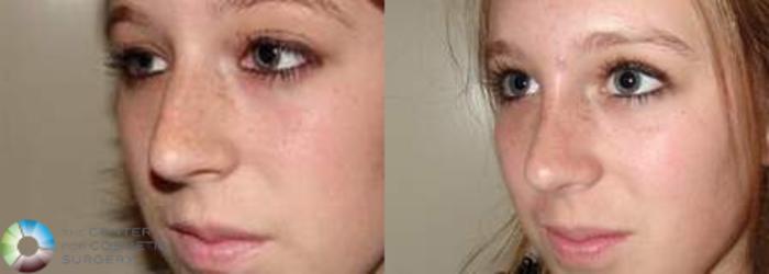 Before & After Rhinoplasty Case 572 View #2 View in Golden, CO