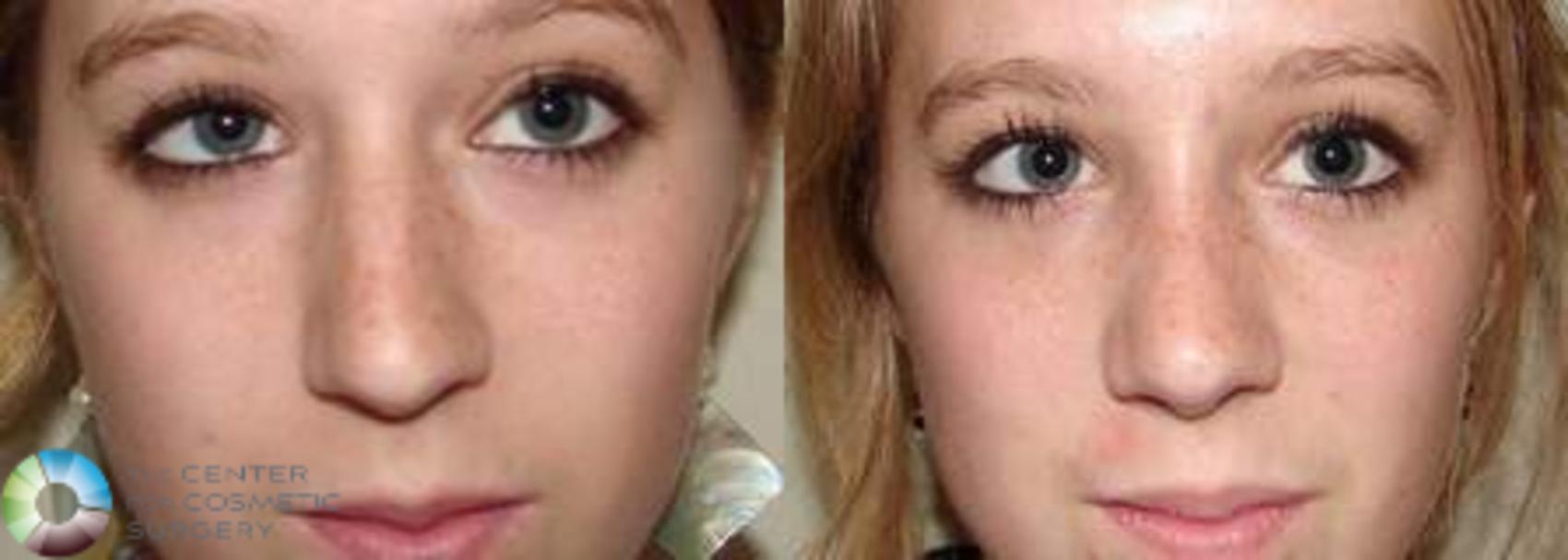 Before & After Rhinoplasty Case 572 View #3 in Denver and Colorado Springs, CO