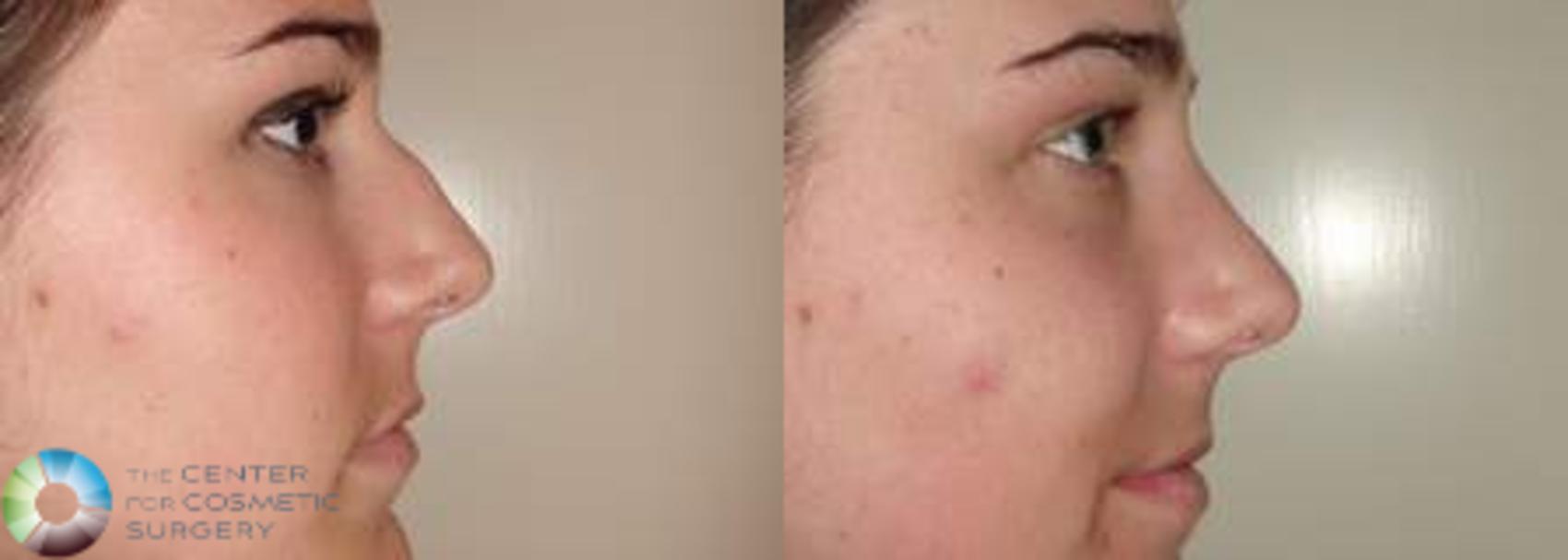 Before & After Rhinoplasty Case 573 View #1 View in Golden, CO