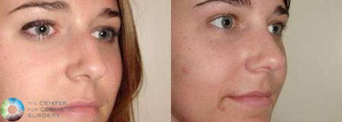Before & After Rhinoplasty Case 573 View #2 View in Golden, CO
