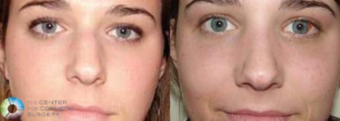 Before & After Rhinoplasty Case 573 View #3 View in Golden, CO