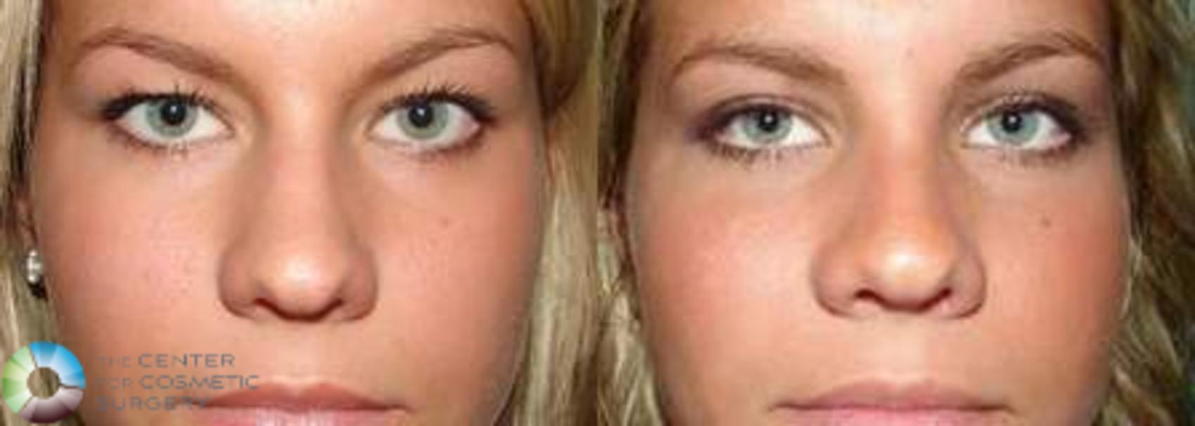 Before & After Rhinoplasty Case 574 View #1 View in Golden, CO