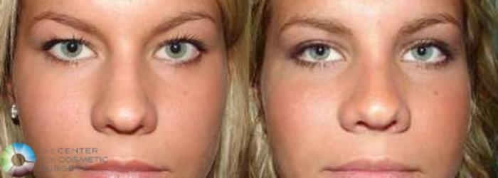 Before & After Rhinoplasty Case 574 View #1 in Denver and Colorado Springs, CO