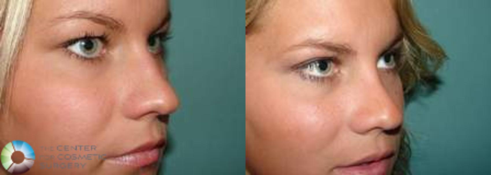 Before & After Rhinoplasty Case 574 View #2 View in Golden, CO