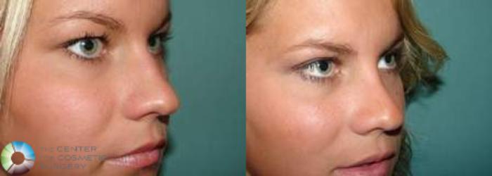 Before & After Rhinoplasty Case 574 View #2 in Denver and Colorado Springs, CO