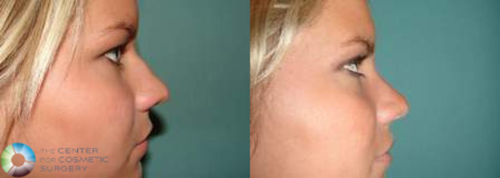 Before & After Rhinoplasty Case 574 View #3 View in Golden, CO