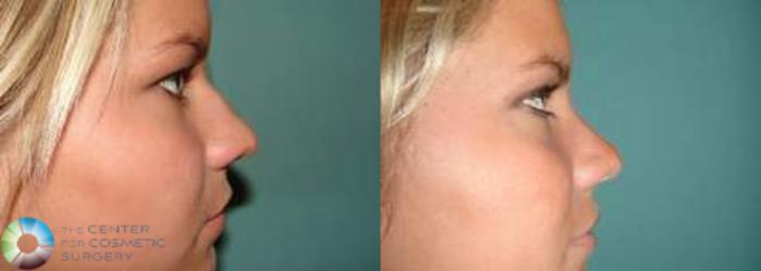 Before & After Rhinoplasty Case 574 View #3 in Denver and Colorado Springs, CO