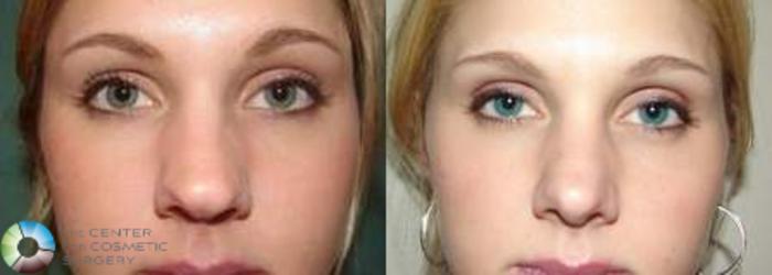 Before & After Rhinoplasty Case 575 View #1 View in Golden, CO