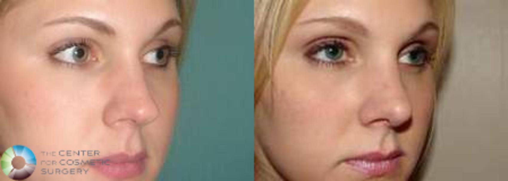 Before & After Rhinoplasty Case 575 View #2 in Denver and Colorado Springs, CO