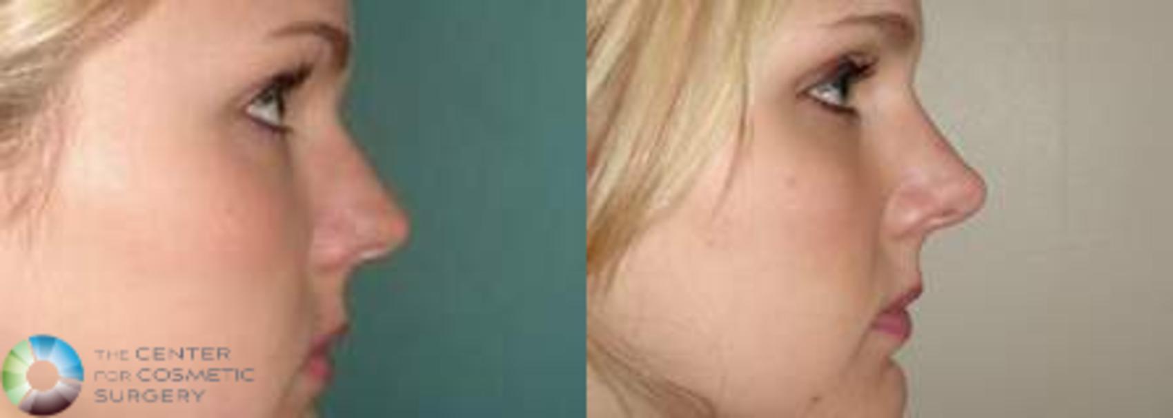 Before & After Rhinoplasty Case 575 View #3 in Denver and Colorado Springs, CO