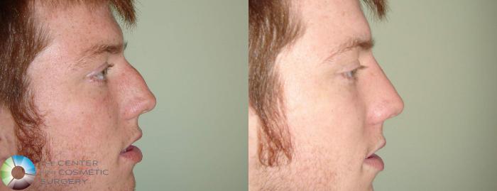 Before & After Rhinoplasty Case 606 View #1 View in Golden, CO