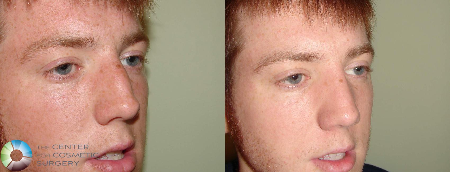 Before & After Rhinoplasty Case 606 View #2 in Denver and Colorado Springs, CO