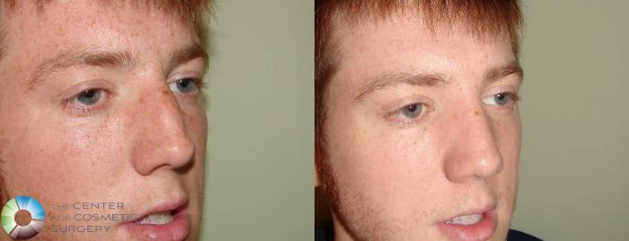Before & After Rhinoplasty Case 606 View #2 View in Golden, CO