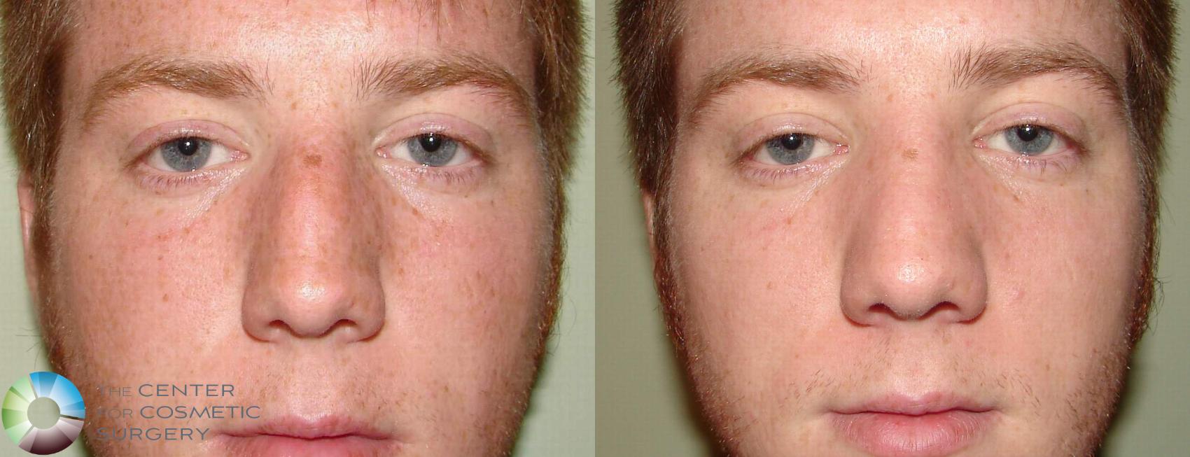 Before & After Rhinoplasty Case 606 View #3 in Denver and Colorado Springs, CO