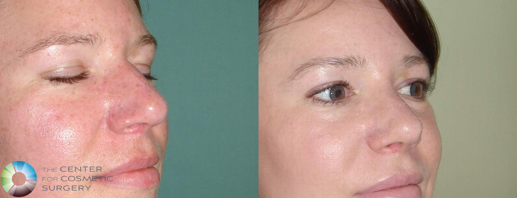 Before & After Rhinoplasty Case 607 View #2 in Denver and Colorado Springs, CO