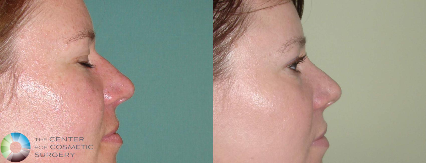 Before & After Rhinoplasty Case 607 View #3 in Denver and Colorado Springs, CO